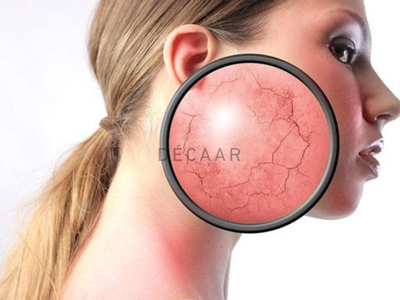 da nhiễm corticoid có chữa được không